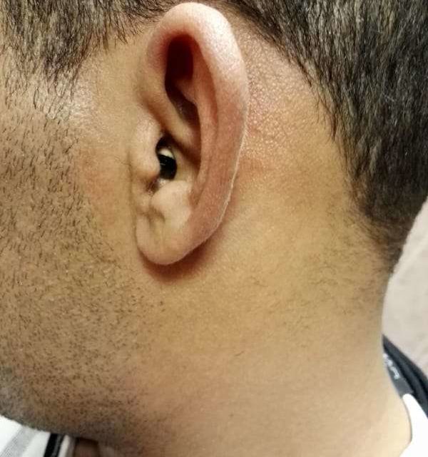 Micro auricolare nell’orecchio per i test della patente, 27enne prima in ospedale e poi arrestato