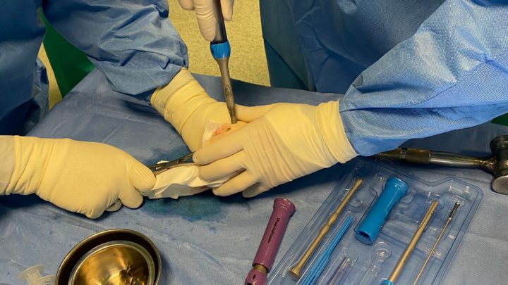 Cassino – Intervento ortopedico di trapianto osteo-Cartilagineo da osso di cadavere eseguito all’ospedale Santa Scolastica