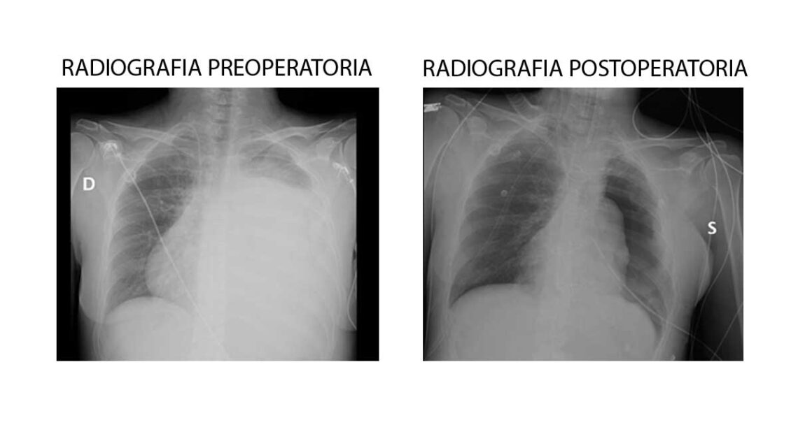 Al Gemelli a Roma asportata una neoplasia rara di grandi dimensioni a una giovane trentenne Al Gemelli a Roma asportata una neoplasia rara di grandi dimensioni a una giovane trentenne