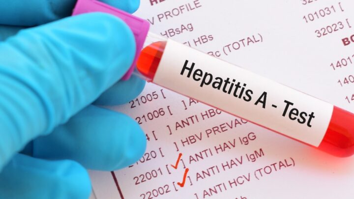 Emergenza Epatite A, 24 casi in provincia di Latina. La Asl istituisce task force per controlli